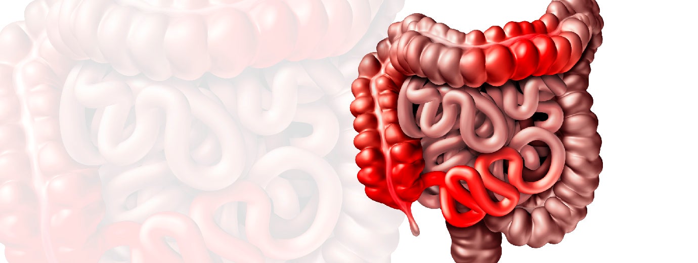 Mitos e verdades nas Doenças Inflamatórias Intestinais