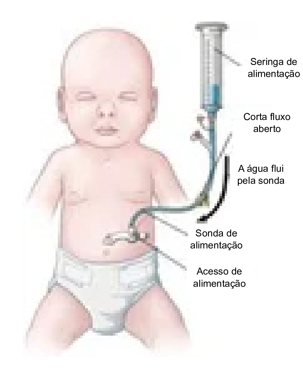 Bebê com seringa e sonda de alimentação, mostrando o acesso de alimentação.