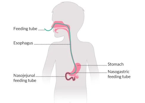 Esquema de tubos de alimentação nasogástrico e nasojejunal.