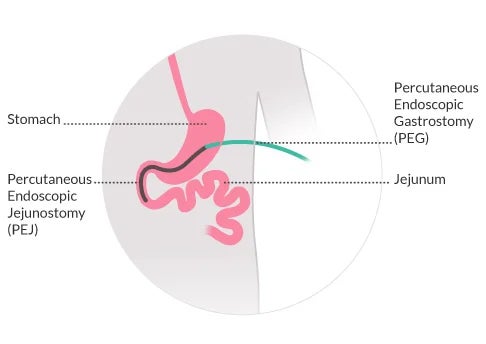 Ilustração com PEG e PEJ no sistema digestivo.